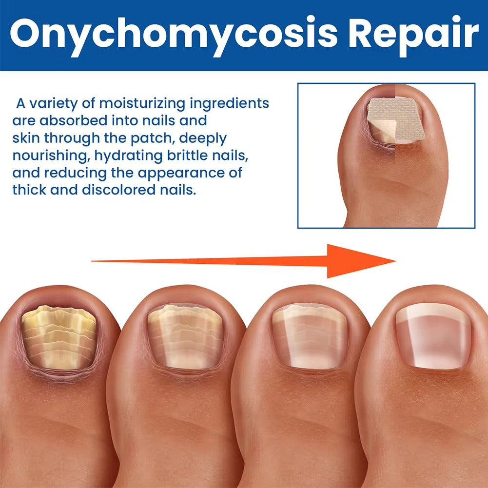 Nail Nurture™ protiplísňové polštářky na opravu nehtů