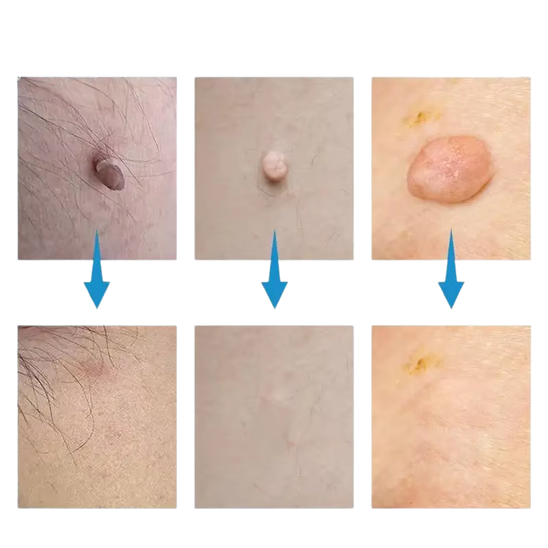 Sada na odstranění krtků SkinSilence™